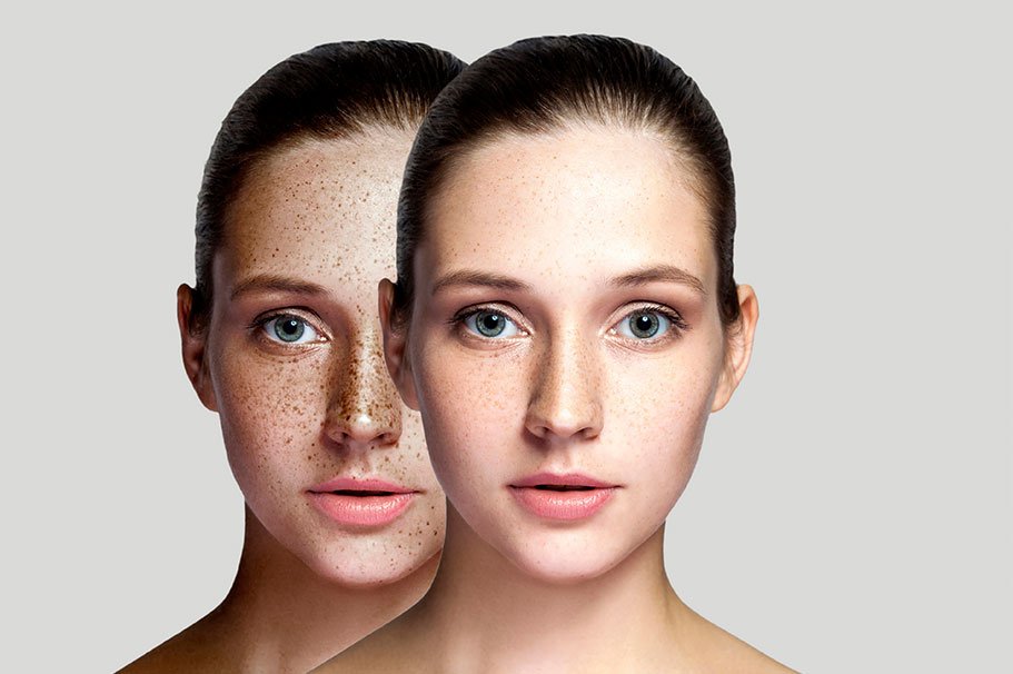 Laser Treatments 1