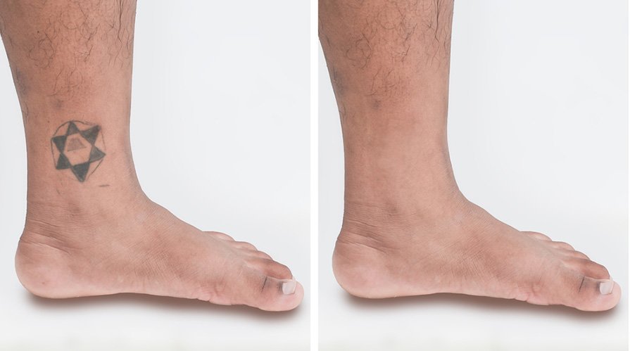 Laser Treatments